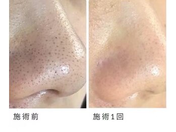 エステサロン クブ(Kubu)/まだイチゴ鼻で悩んでますか？