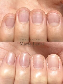 マリーロール 梅田店(Marie Laure)/自爪育成/深爪矯正/ネイルケア