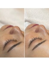 レイビューティサロン(Lei beauty salon)/1回の施術でむき卵肌に◎