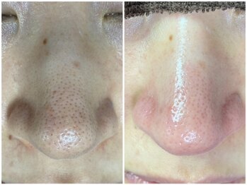 クオーレ(cuore)/毛穴エクストラクション