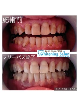 シフォン 豊田店/3週間通い放題フリーパスコース