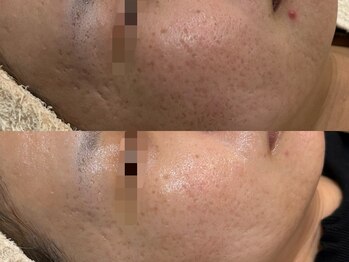 エミュ(emu)/ニキビ毛穴もお手のもの!!