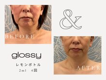 グロッシー(glossy)/【症例】レモンボトル頬50代