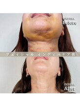 術後の女神 大阪心斎橋店/術後ケアインディバ・インディバ