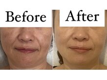 サロン マリー(SALON MARIE)/改善が難しいシミ　３回目の変化