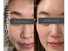 アンビワン(Anbione.)の雰囲気（話題のNMNで”細胞からレベルから働きかける”新感覚ピーリング）