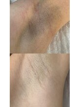 スキンラウンジ(SKIN LOUNGE)/圧倒的効果｜LED脱毛