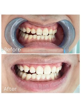 ウルト(ULT)/セルフホワイトニング