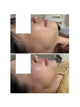 ユウドット(yuu.)/シミケアbefore after