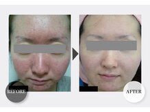 インナーメス(INNER MES)/お悩み肌を土台から！