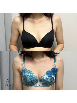 ジュリア(JULIA)/【バストアップ/育乳　症例】