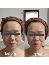 リルーチェ 倉敷(Riluce)/ヒト幹細胞導入1回の施術