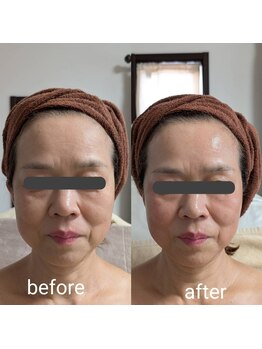 リルーチェ 倉敷(Riluce)/ヒト幹細胞導入1回の施術