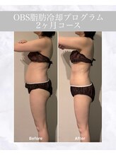 OBS/脂肪冷却プログラム