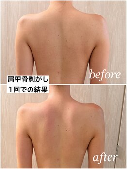 バービーグロウ 恵比寿(Barbie Glow)/肩甲骨剥がし1回での結果
