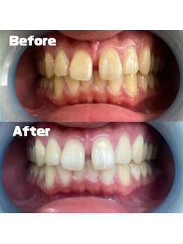 ベルカーラ(Belcarra)/