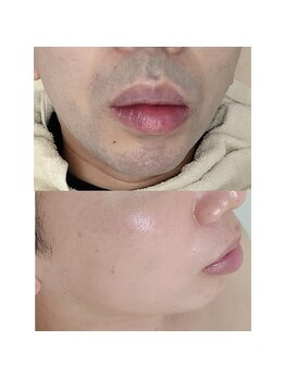 ユニクリア(Uni clear)/大人気★ヒゲ脱毛