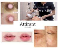 アティロン(Attirant)