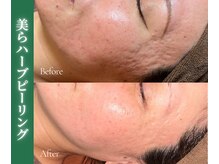 アイランドハーブ 沖縄おもろまち店/ハーフピーリング