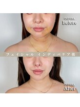 術後の女神 大阪心斎橋店/術後ケアインディバ・インディバ