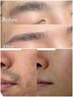 【眉とメンズ脱毛】清潔感UP！　眉waxとメンズ光脱毛（ヒゲor膝下）￥8,800