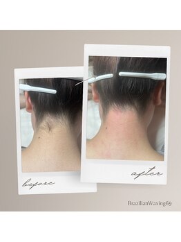 ブラジリアンワキシング シックスナイン(BrazilianWaxing69)/女性 / うなじ