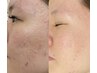 驚異のスピードで効果を実感！プロセルセラピーズで肌質改善♪毛穴、ニキビ