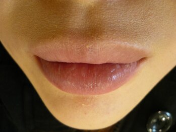 ハーティービーム(Hearty Beam)/ビームオンリップエステ 