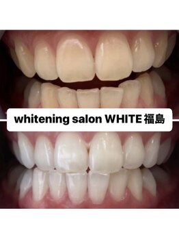 ホワイトニングサロン ホワイト(WHITE)/セルフホワイトニング効果