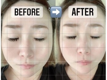 ベア(Bea)/【速攻小顔コース】1回の変化