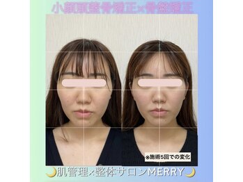 メリー(merry)/小顔頭蓋骨矯正◎二重顎 むくみ