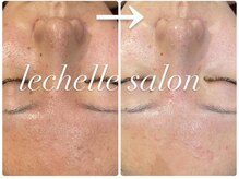 レシェルサロン(Lechelle Salon)/ハーブピーリング