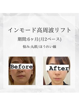 メディカルエステ 東銀座店/業界初インモード高周波リフト 