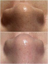 スパークル/毛穴/ワックス脱毛/脱毛