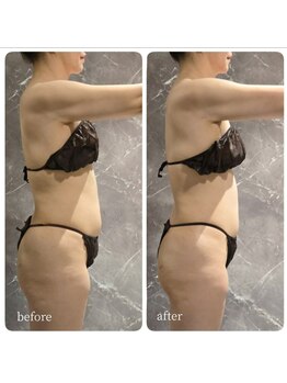 インディバ 六本木/【上半身集中】before→after