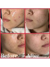 オルズ(Olu's)/ハーブピーリング｜ニキビケア