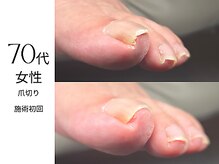 フットケア クラッシー(footcare classy)/爪切りで痛みを抑える♪