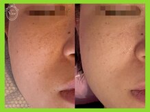 ハーブピーリング 名古屋/韓国水光ハーブピーリング