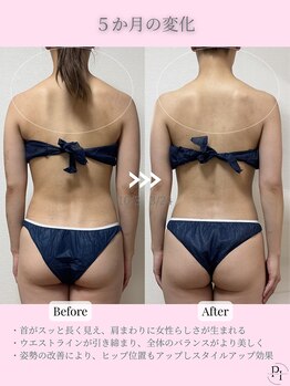 プラスワンビューティテン 新大阪店(Plus One Beauty)/ボディ/ハイパーナイフ/痩身