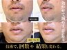 【ヒゲ脱毛+首】濃いヒゲも効かせる設計脱毛 ¥14,500→初回¥12,000