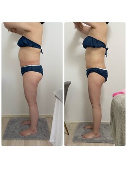 エステサロンブランシュ(Esthe salon Blanche)/ハイパーナイフで全身痩せ！