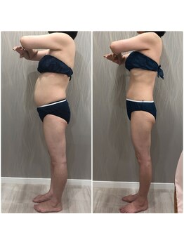 ベルネ(BELLUNE)/ベルネ式フォースカッター