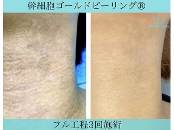 リメイククリニカルビューティー(Remake clinical beauty)/がざがさ色むら