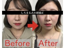 アベックトア(Avectoi)/小顔矯正で顔に自信を持てる