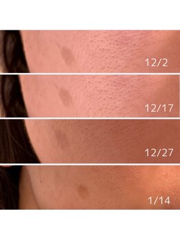 プラウド(Proud)/ケア症例/プラズマ