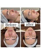 エリシオン(ELYSION)/リフトアップ