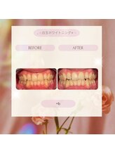プラスビーセルフ(+b self)/ホワイトニングビフォーアフター