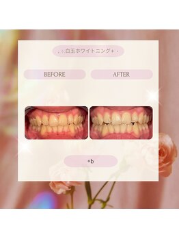 プラスビーセルフ(+b self)/ホワイトニングビフォーアフター