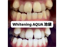 アクア 池袋店(AQUA)/ホワイトニング/池袋/東京/美白