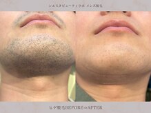 シエスタビューティラボ/【ヒゲ脱毛】まもなく青ヒゲ卒業